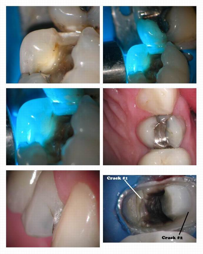 Resize of Cracked teeth pg 2.jpg